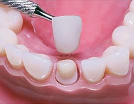 Dental Crowns